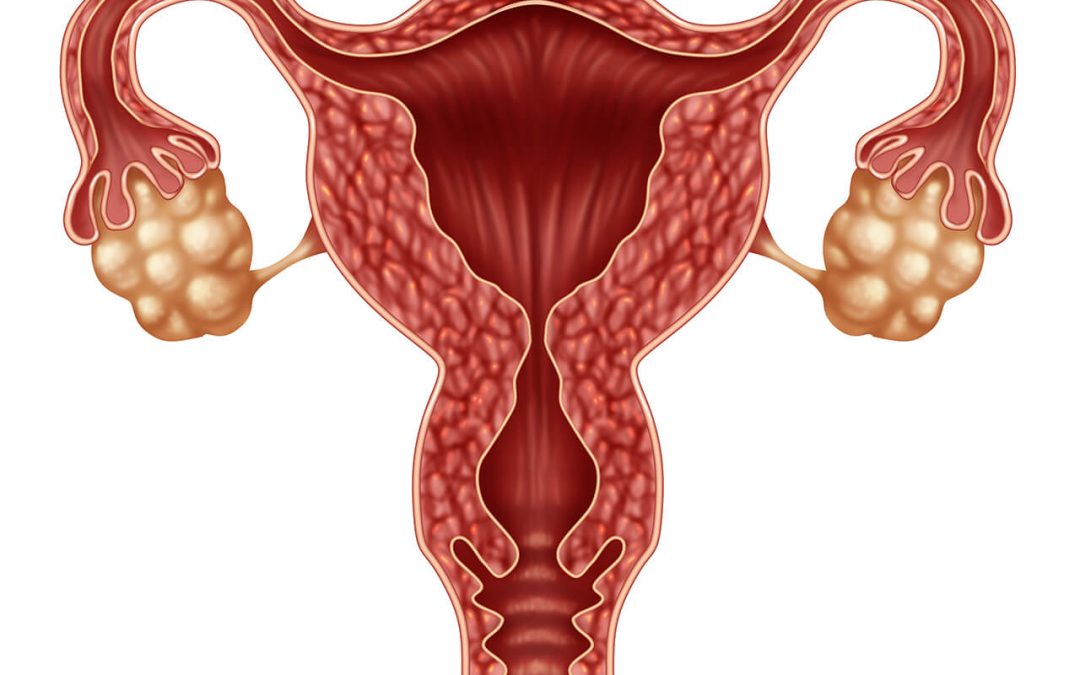 ¿Qué causa el cáncer en cuello del útero?
