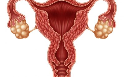 ¿Qué causa el cáncer en cuello del útero?