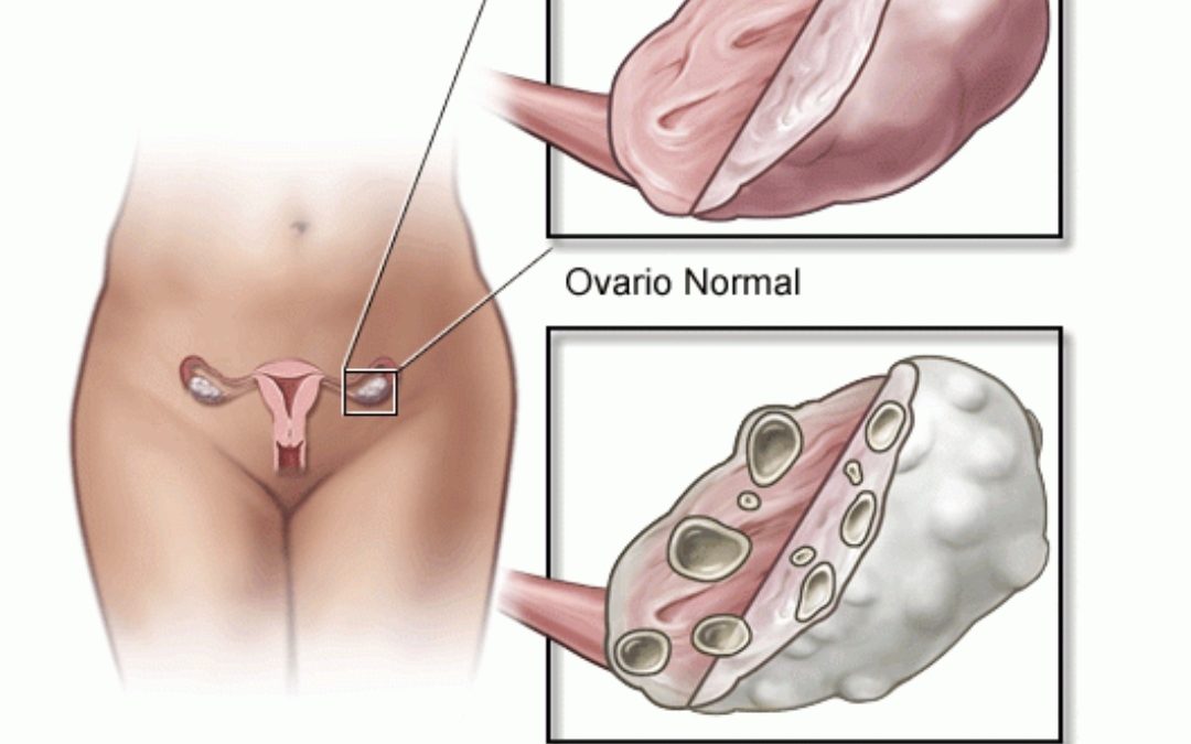 Los 5 puntos que debes de saber sobre el ovariopoliquístico